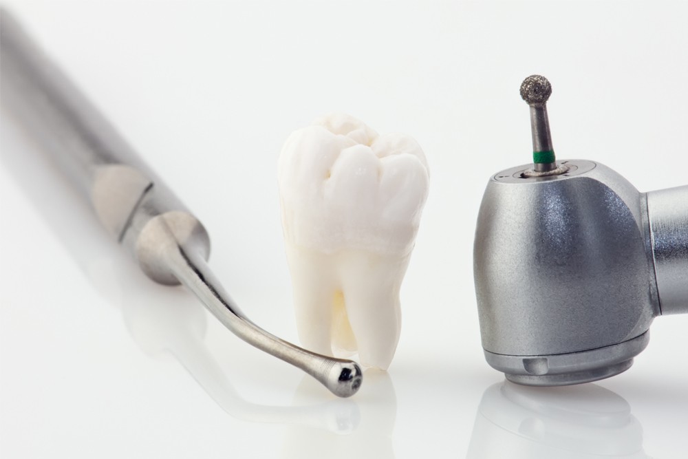 Tratament carie dentara in Chisinau, Davinci dental clinic